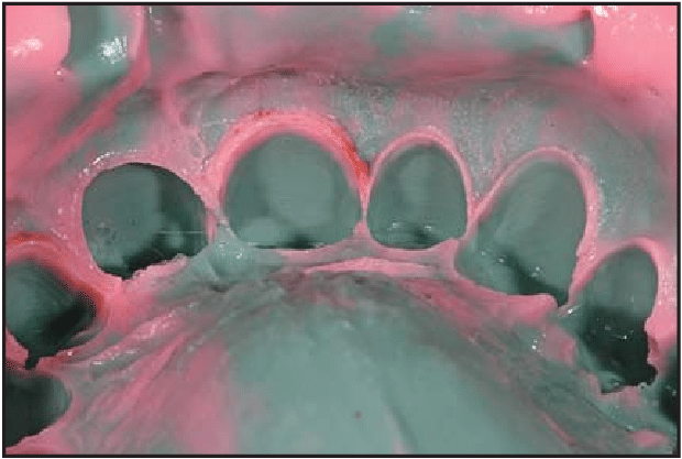 Hydrocolloids In Dentistry